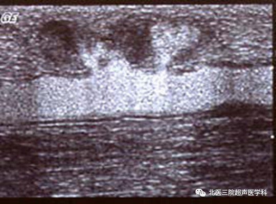 彩色多普勒超声在自体动静脉瘘监测中的作用