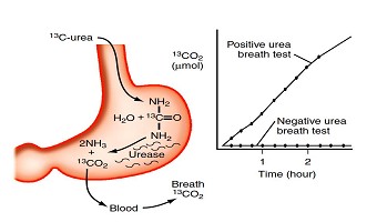 终结幽门螺杆菌的一切疑问,专家帮您健康无“幽”