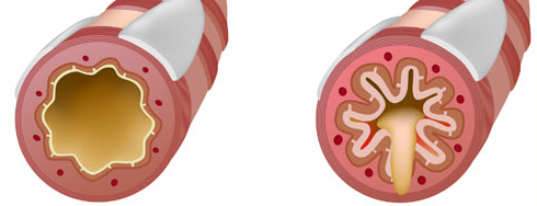 缩 唇 呼 吸 与 腹 式呼 吸