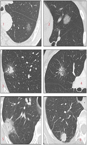 肺结节=肺癌?别再自己吓自己啦!