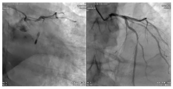 北医三院多学科合作成功救治一例心梗后心脏骤停、心脏破裂、寡妇病变患者