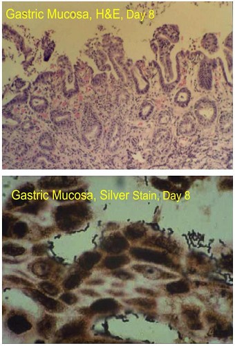 终结幽门螺杆菌的一切疑问,专家帮您健康无“幽”