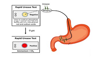 终结幽门螺杆菌的一切疑问,专家帮您健康无“幽”