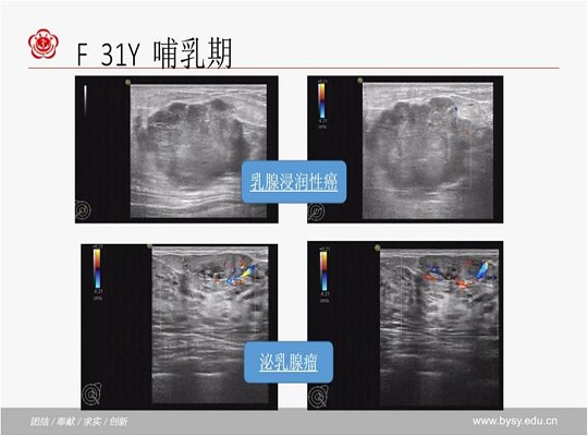 乳腺疾病之哺乳期乳腺癌