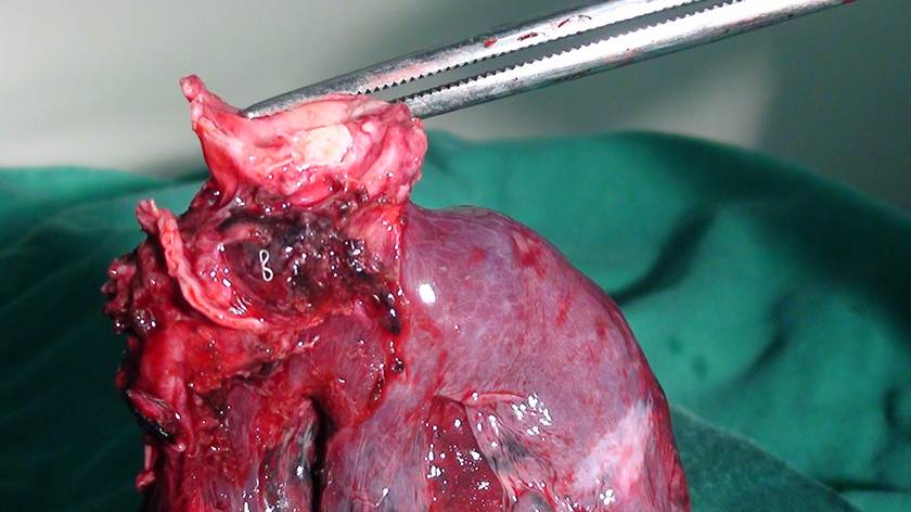 腔镜袖状切肺难 多科协作救重患 胸外麻醉血管介入手术室SICU联手成功救治术后重度急性肺栓塞