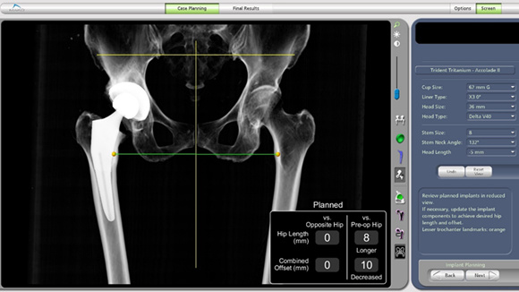 骨科完成我院首例骨科机器人辅助髋关节置换术