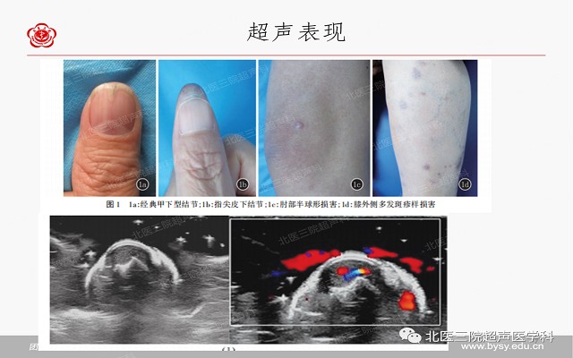 五大痛性浅表肿瘤（一）