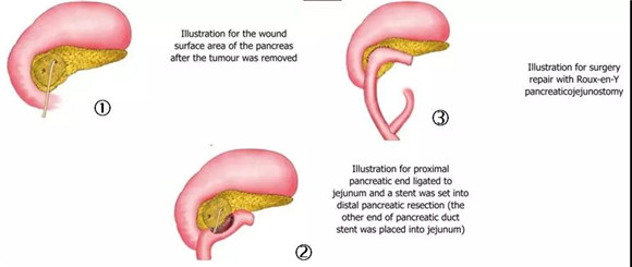 从“四切三吻合”到“一切一吻合” ——胰头部良性肿物切除新术式【2018 技术创新一等奖】