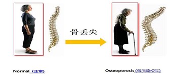 预防骨质疏松,这个检查越早做越好!