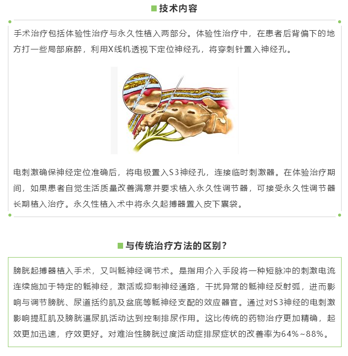 三院新技术 | 膀胱起搏器——难治性膀胱过度活动症患者的福音