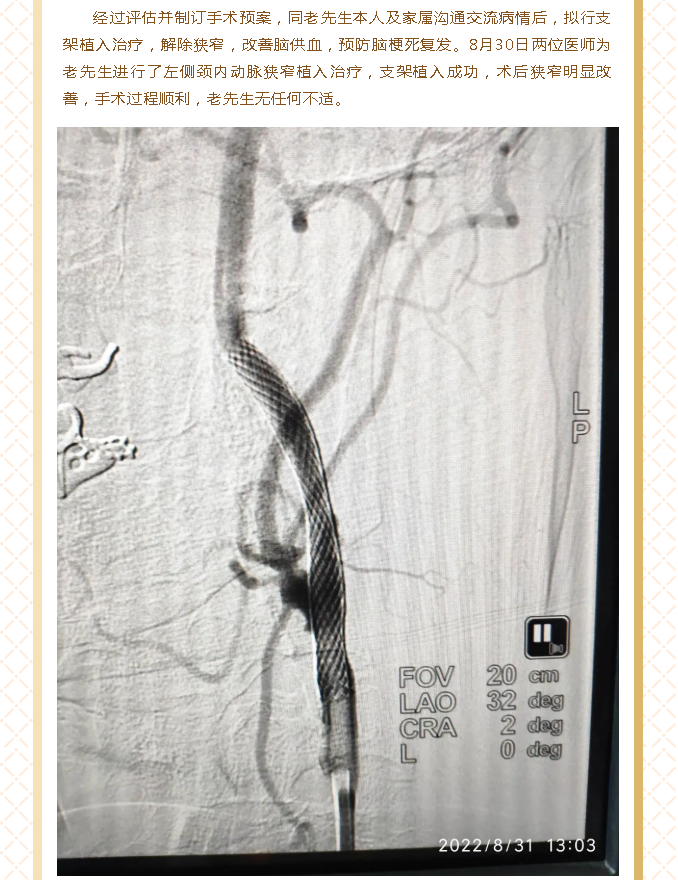 北医三院机场院区导管室顺利开展首例脑血管造影及颈动脉狭窄支架植入术