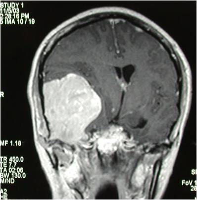 巨大中颅底脑膜瘤切除术
