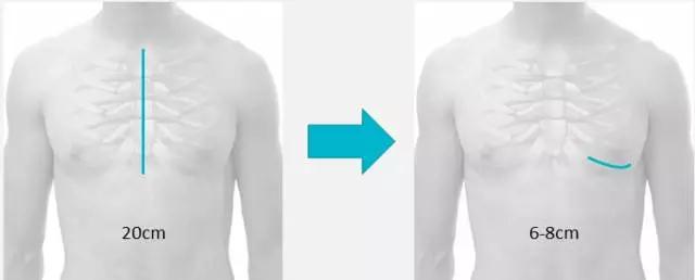 小切口,大不同,微创搭桥开创新天地